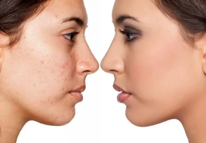 Chemical Peels vs. Microdermabrasion: Which is the Better Treatment for You?