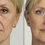 How Long Do Botox and Dermal Fillers Last?